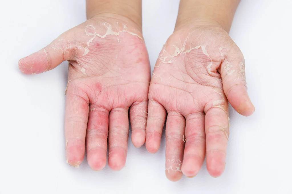 Fungal skin infections treatment